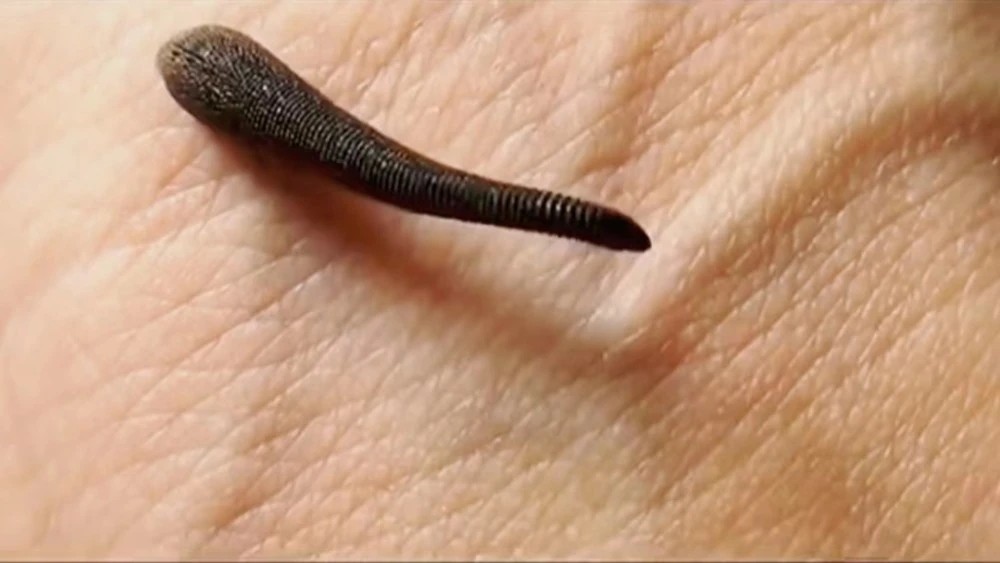 蚂蟥爬进眼睛怎么自救,遇到蚂蟥怎么自救