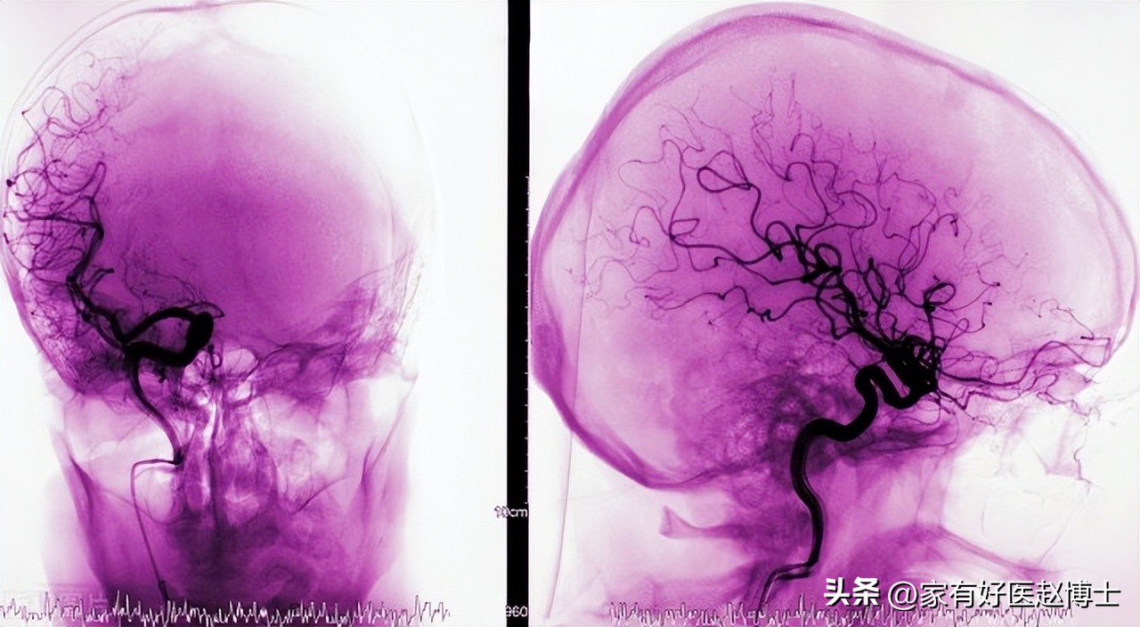 吃了降压药后头晕是什么原因,吃了降压药头更晕是什么原因