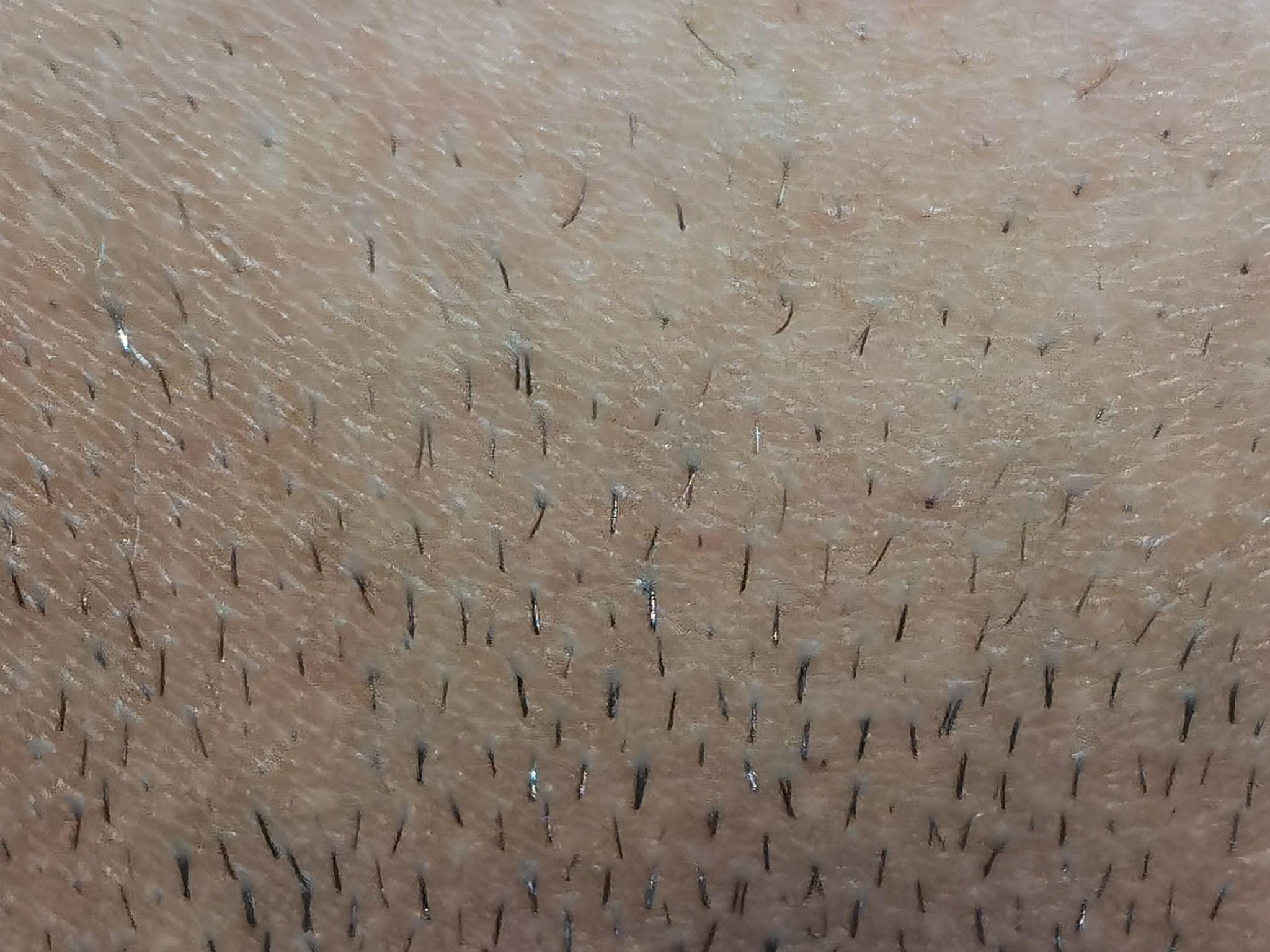 女性毛发越来越重是什么原因,女人毛发脱落严重