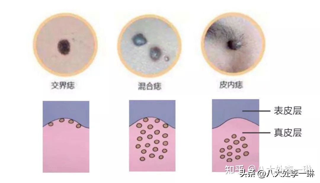 色素痣的形成原因及去除方法,无色素痣和色素痣的区别