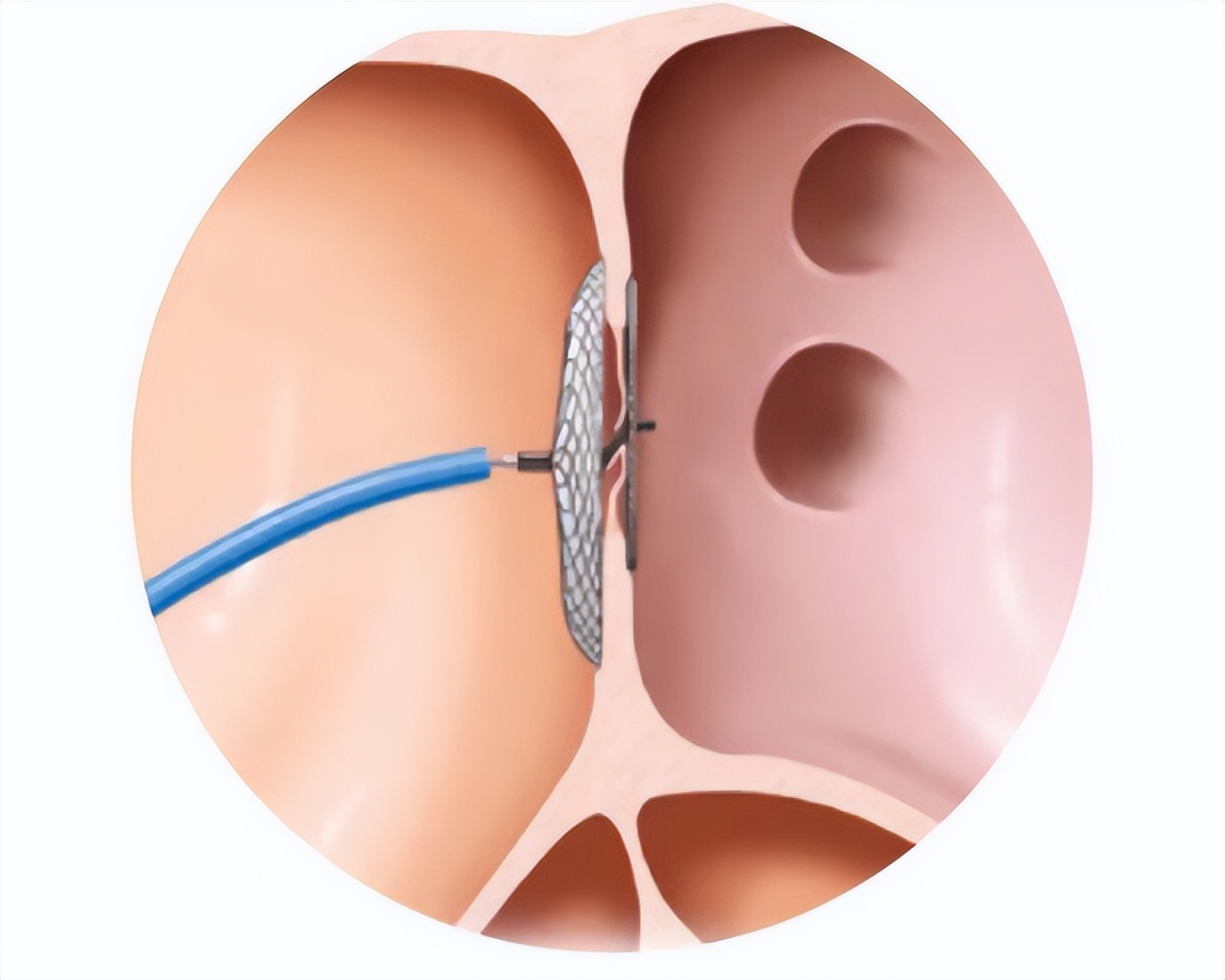 “脑”病“心”治,关闭“小心眼”——汾阳医院心内科二病区成功实施吕梁首例经导管卵圆孔未闭封堵术