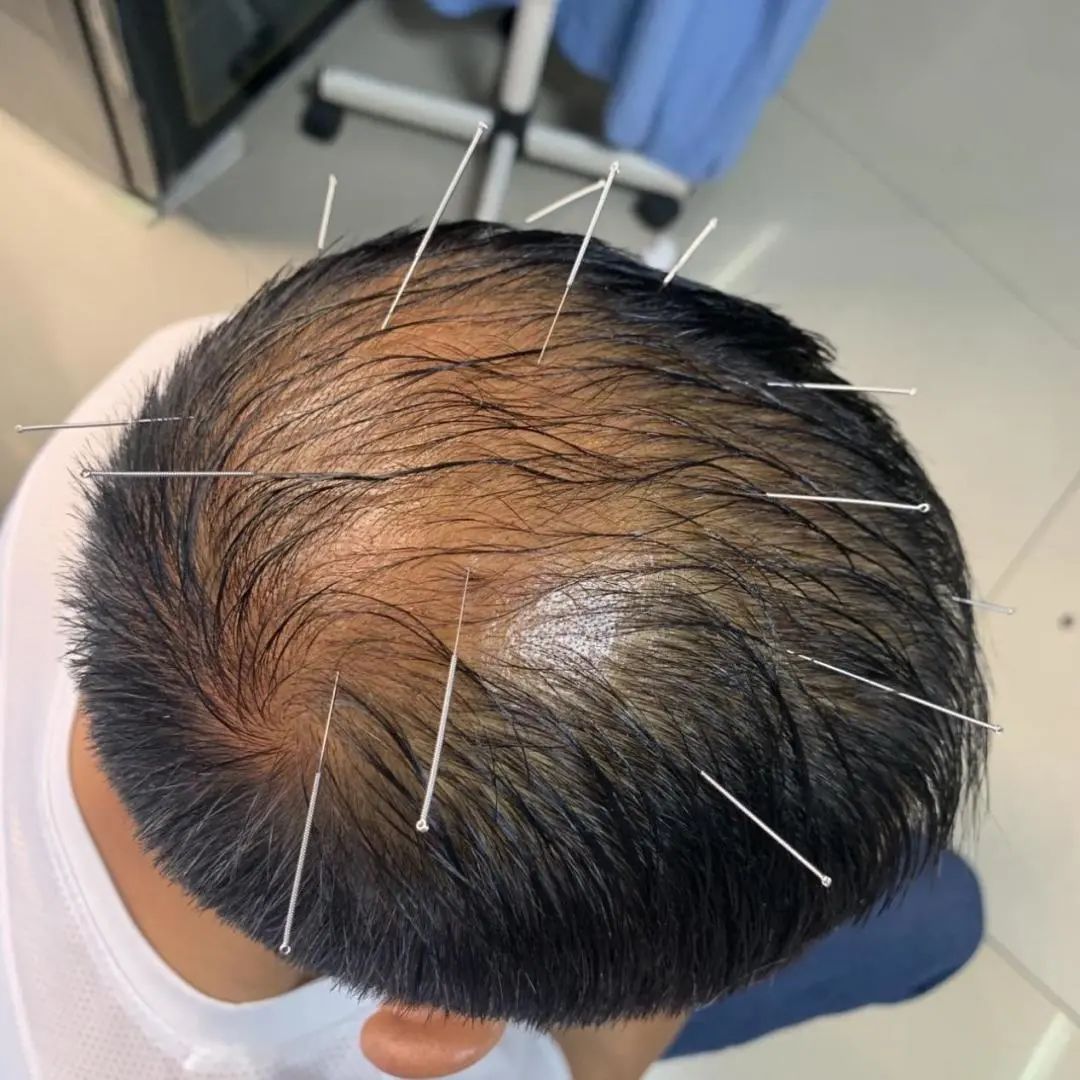 发际线头发稀少吃中药能调节吗,中医治发际线最好的方法