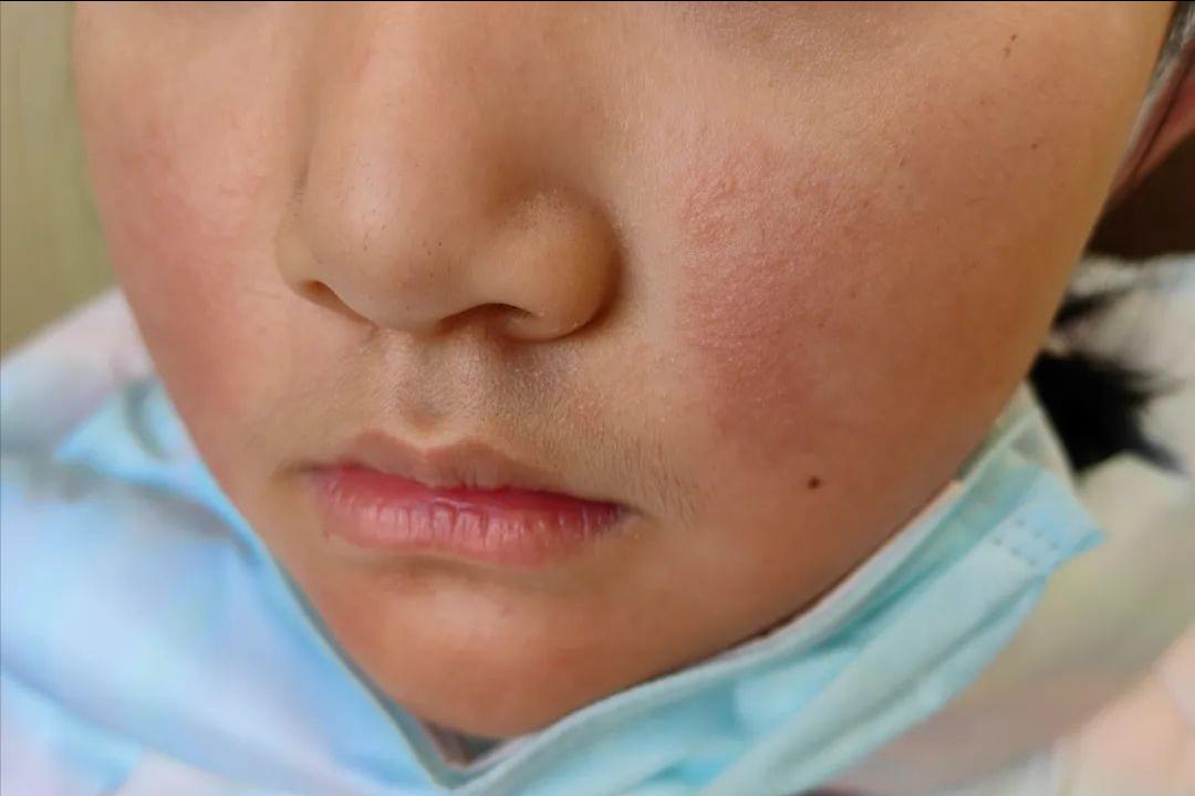 面部皮炎是炎症吗,脂溢性皮炎面部痒