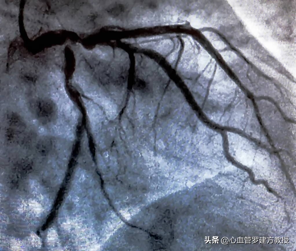 做了冠脉造影需要注意什么,冠脉造影怎么做