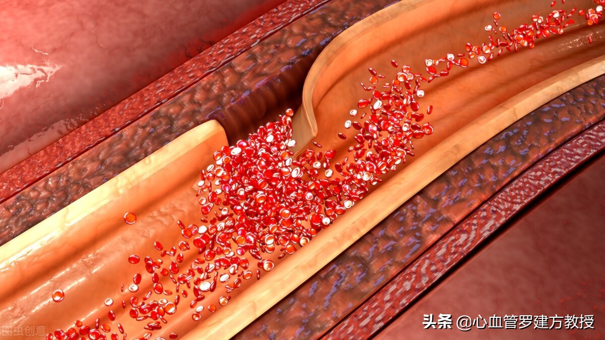 主动脉夹层动脉瘤什么原因造成的,主动脉夹层动脉瘤是什么症状