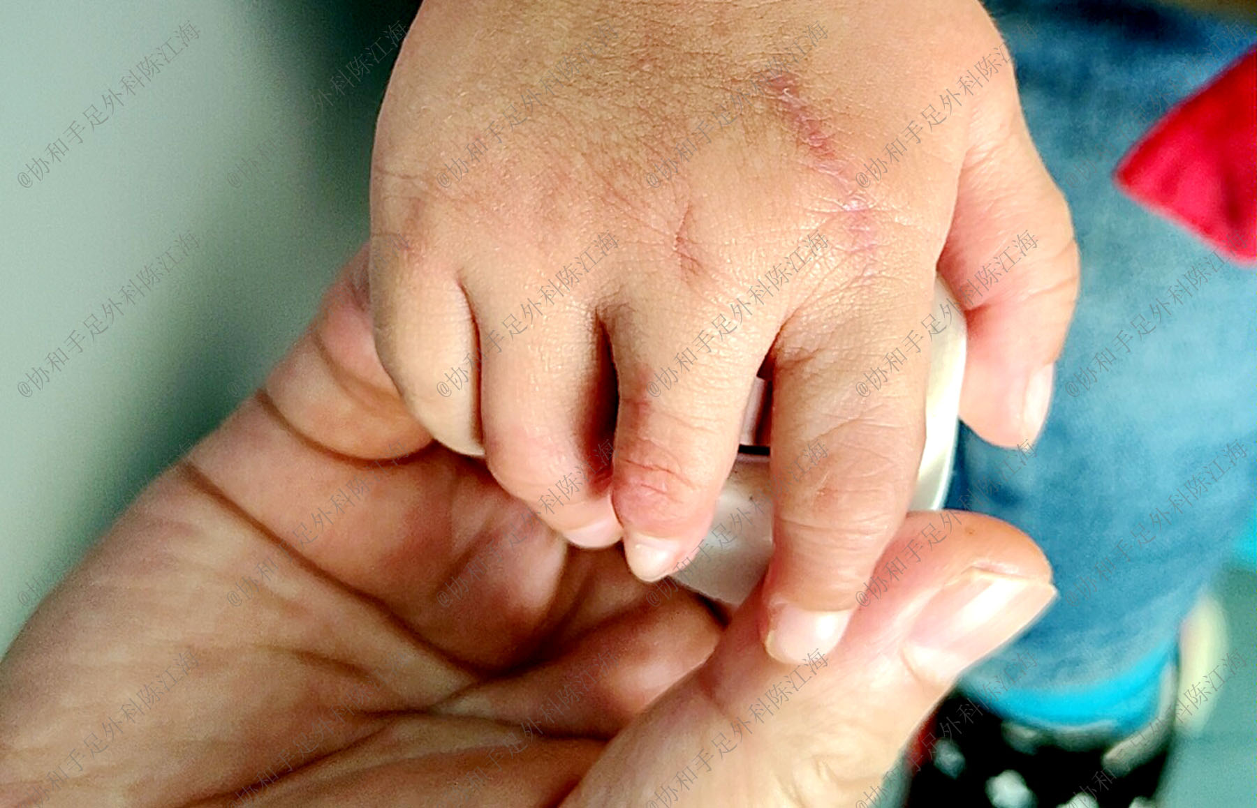 6个月宝宝手短,六个月宝宝手指肿胀怎么回事