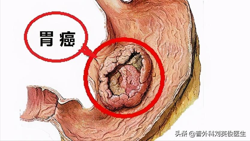 吃动物血排黑色大便是怎么回事,吃了动物血大便变黑是肺在排毒吗