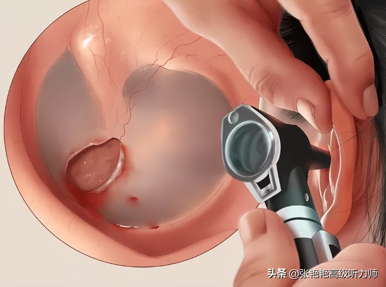 鼓膜破了还能修复好吗,鼓膜破了对听力有影响吗