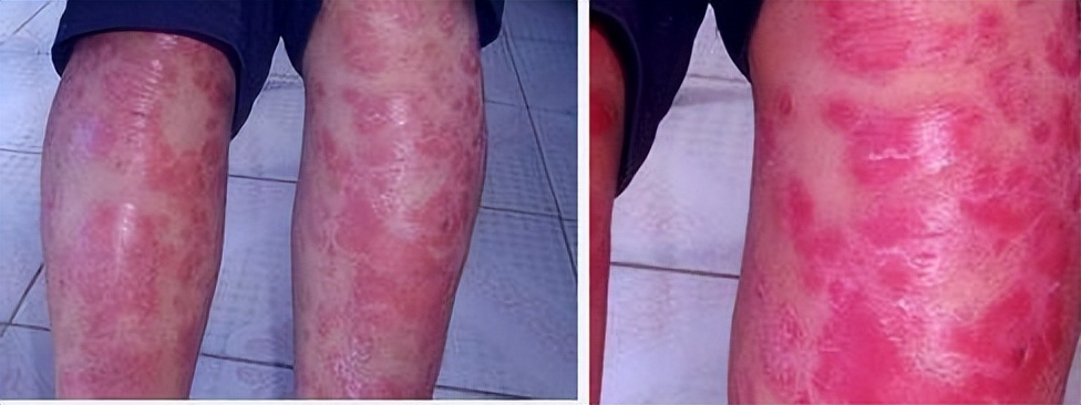 银屑病中医彩色图谱,银屑病舌象分型