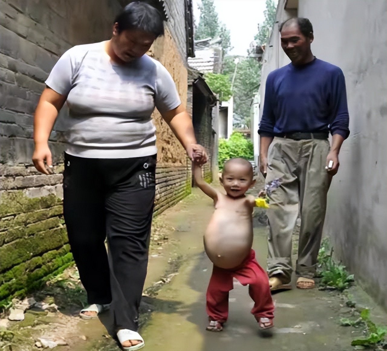 女童肚子超大疑似怀孕,2岁女婴肚中发现“胎儿”