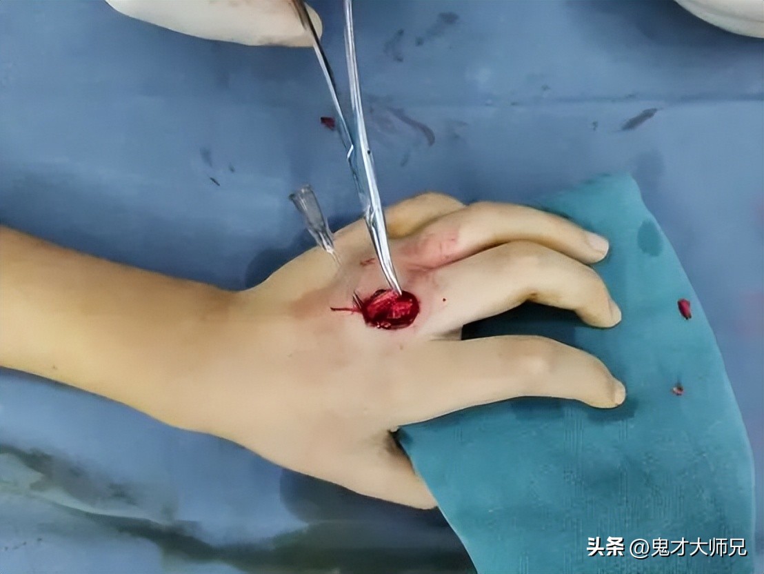 家长小心！仅几分钟吹伤5岁男娃，罪魁祸首竟是这样东西！