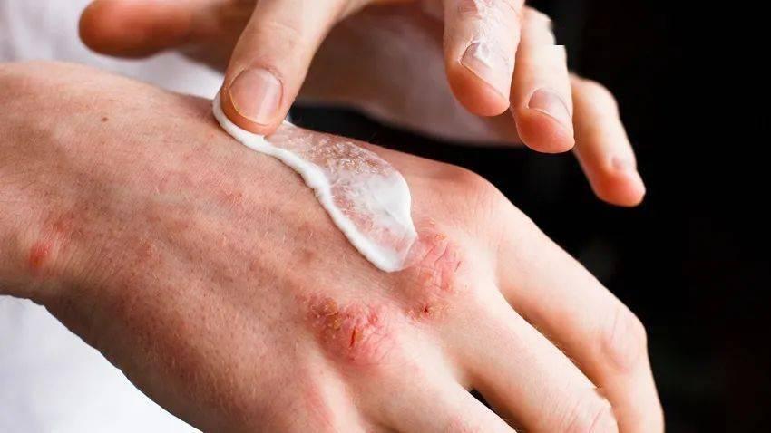 汗疱疹特别痒的时候怎么办,为什么汗疱疹反复发作呢怎么治疗