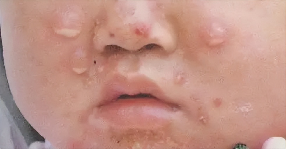 有哪些中成药治真菌肺炎,皮肤病真菌感染用什么药