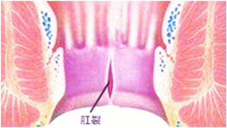 连续熬夜直播三个月后，网红女主播肛裂排便困难
