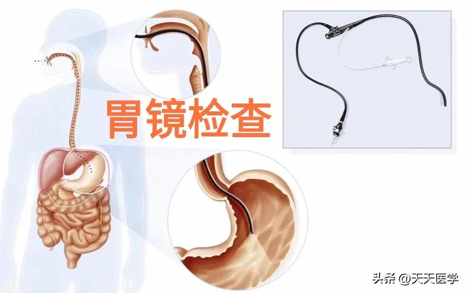 有胃病的人多久做一次胃镜检查,做胃镜是针对哪些胃病的检测手段