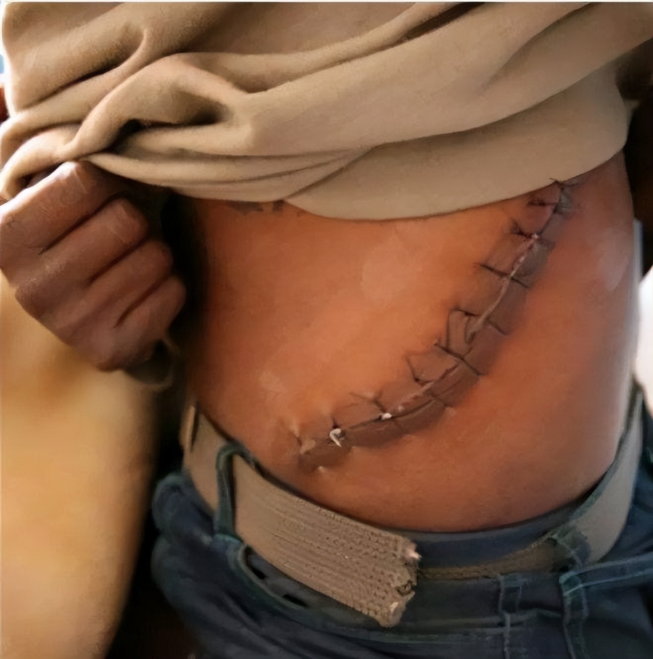 尼泊尔有个单肾村,尼泊尔单肾村的故事