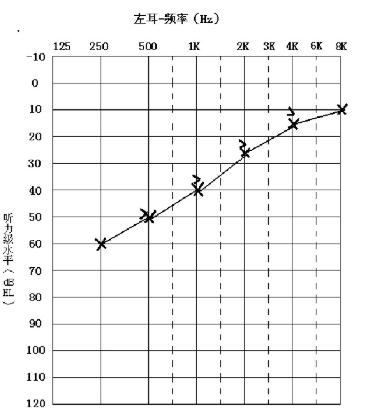突发性耳聋的原因和症状,突发性耳聋的表现及治疗原则是