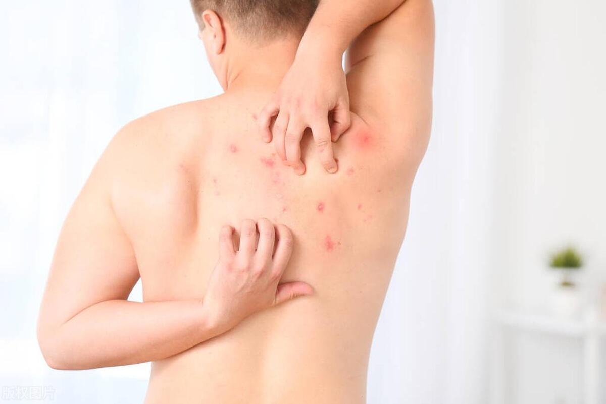 生蛇病难治好吗,生蛇的水泡怎样处理