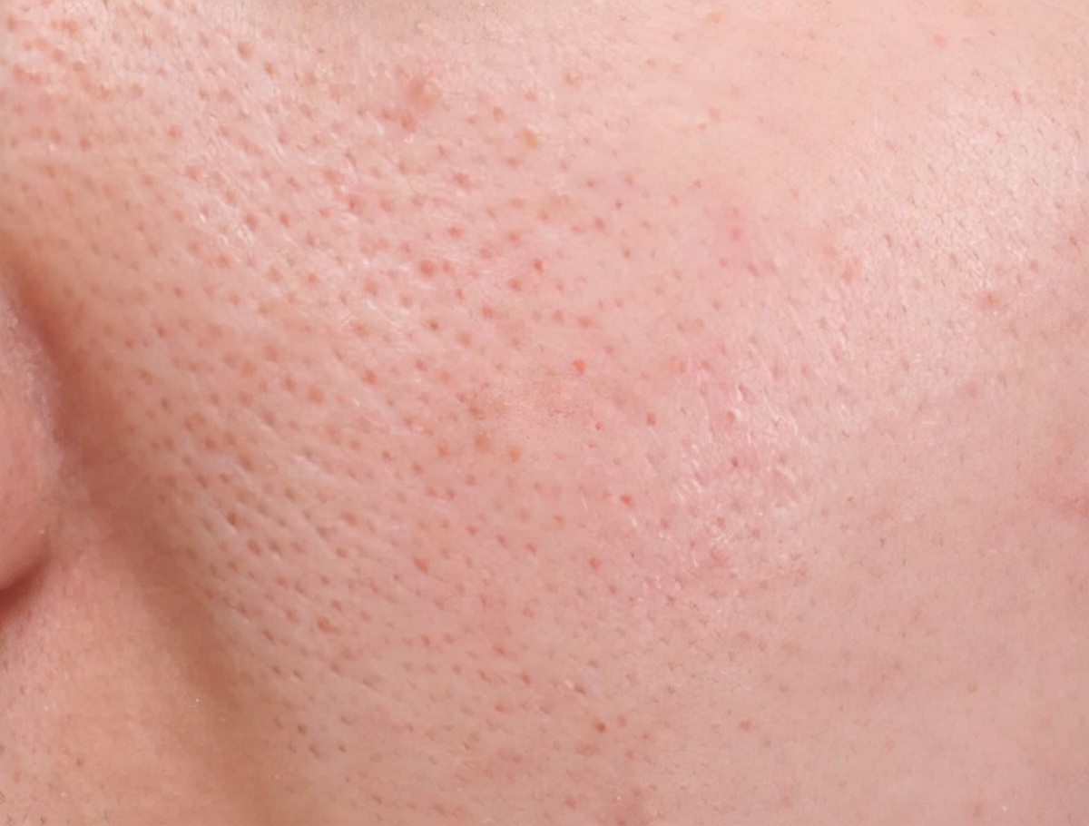 遗传性毛孔粗大,毛孔粗大形成的因素