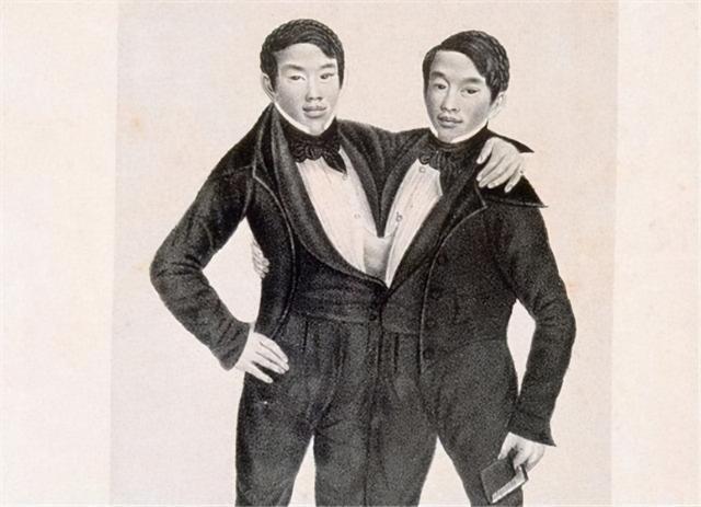 连体人结婚是怎样过日子,连体人如何娶妻生子