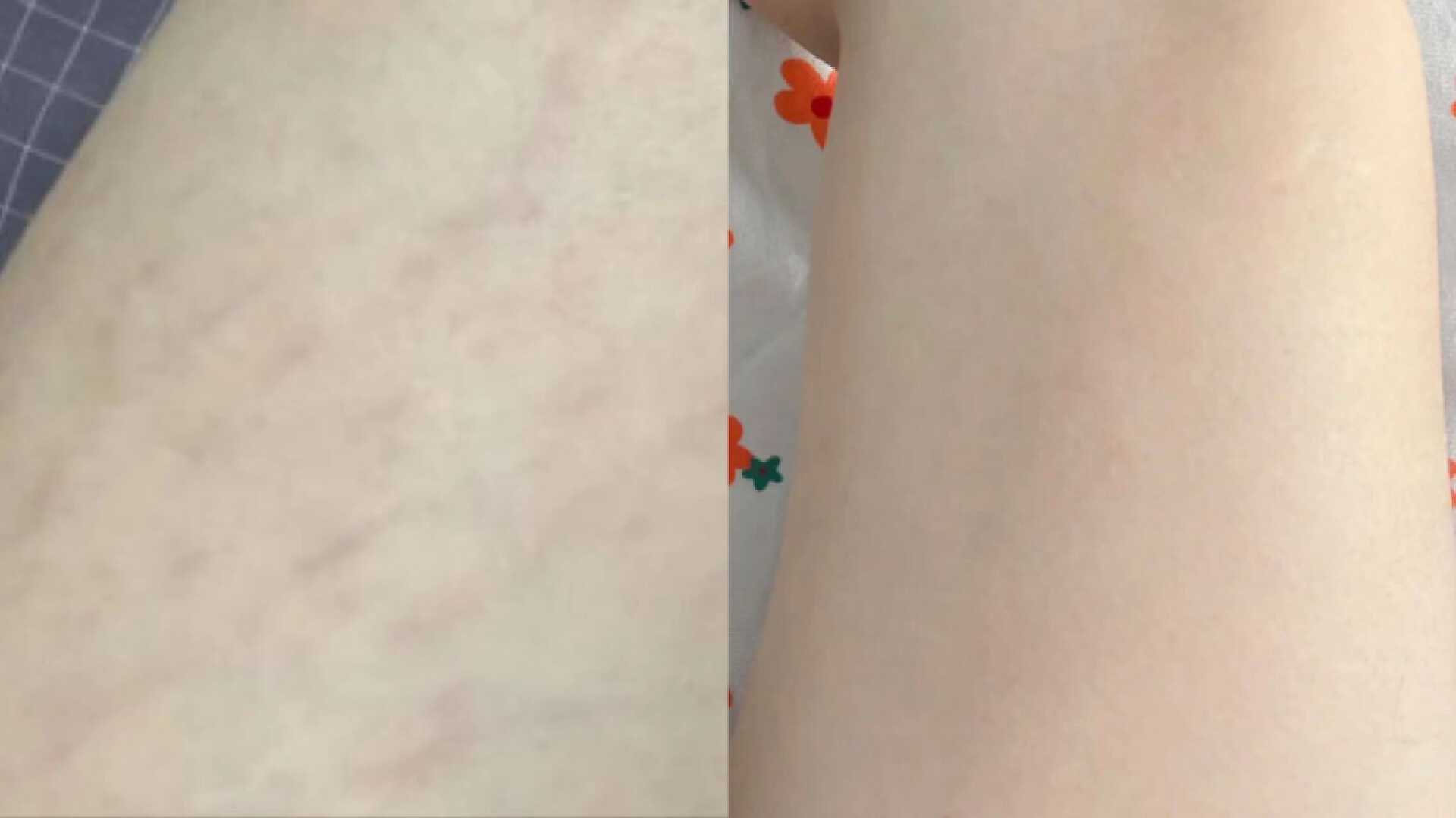 消除妊娠纹是不是智商税,妊娠纹产品是智商税吗