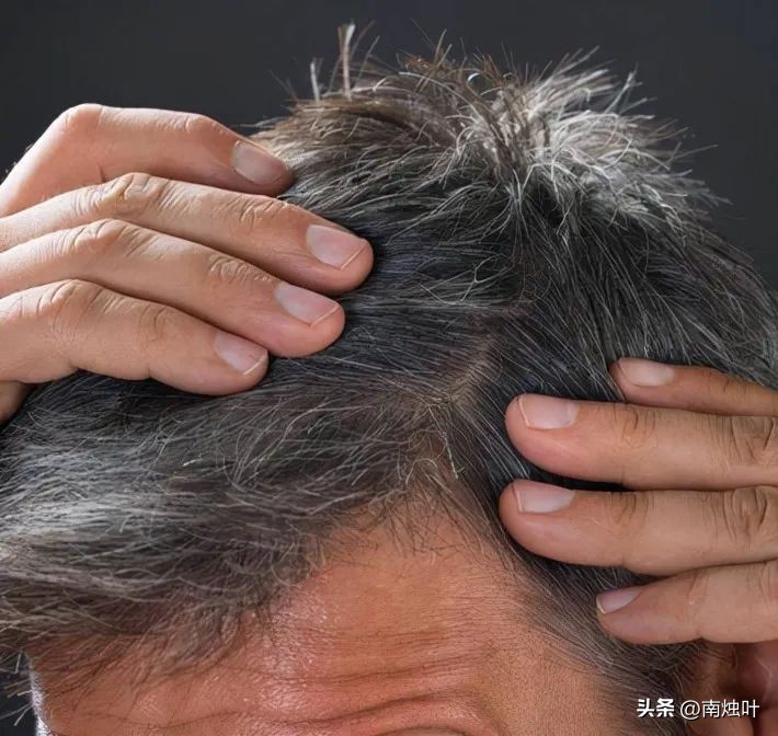 为什么压力大时会长白头发？这些习惯可以控制白发增多！