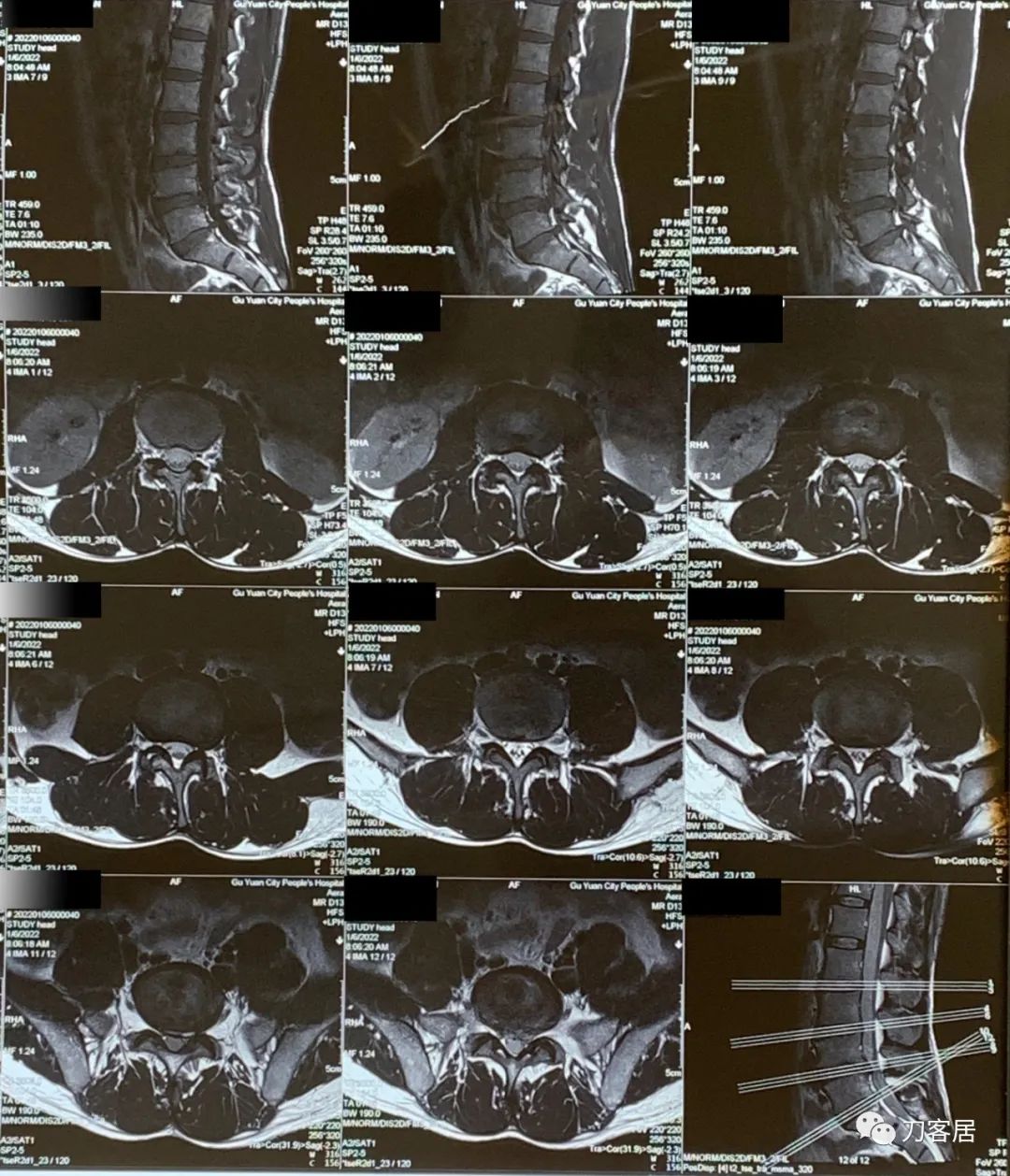 腰椎间盘突出压迫腿疼看神经内科,腰椎间盘突出看骨科还是神经内科