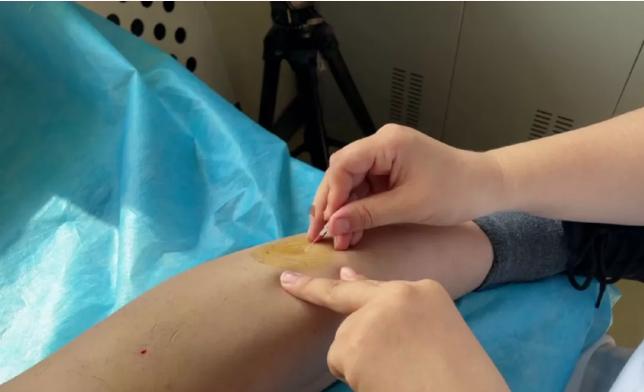 走进中医|运用中医岐黄针对中风后下肢痉挛症状的治疗