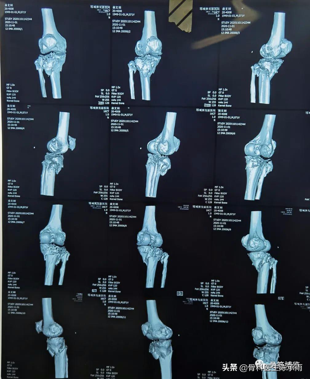 陈旧性腿骨骨折,陈旧性骨折