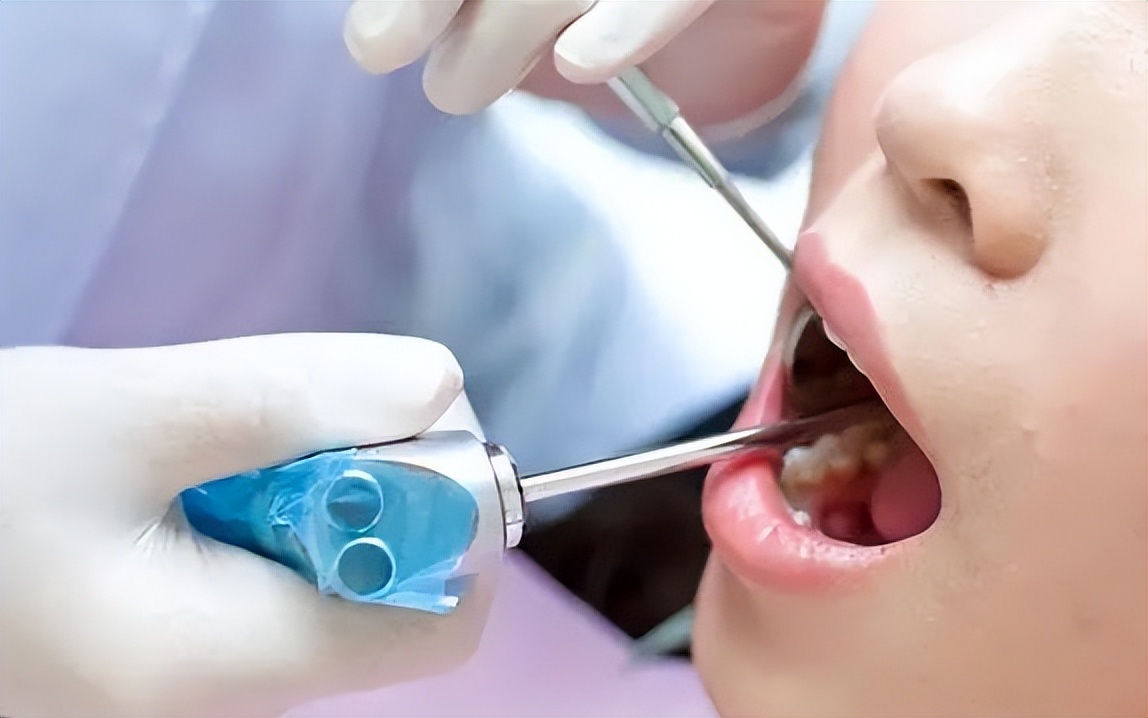 洗牙危害大还是不洗牙危害大,为什么有人说洗牙对牙齿有伤害啊