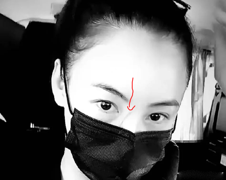 张柏芝晒出怼脸自拍，自曝鼻梁被3岁小儿子抓伤，超长伤疤很明显