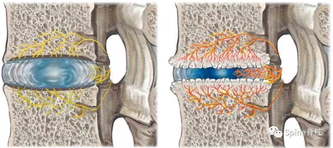 因腰椎问题导致的腰痛,慢性腰骶部疼痛