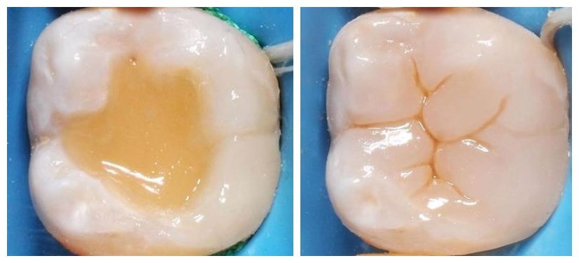 补牙几百对方要三千合理吗,同样是补牙为什么效果不一样