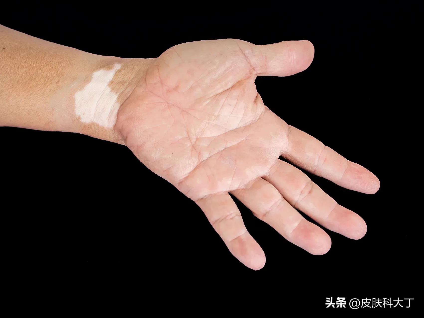 如何让白癜风彻底治愈,让白癜风快速扩散的药方