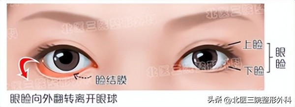 疤痕性眼睑外翻治疗方法,上眼睑疤痕性轻微外翻
