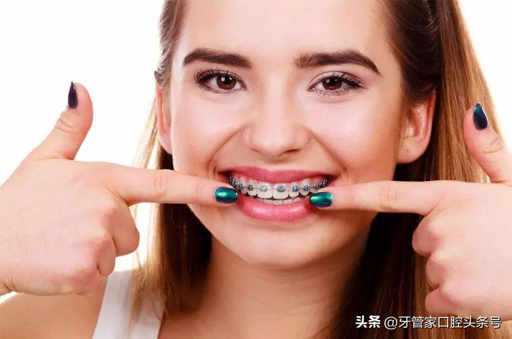 戴隐形矫正牙套注意事项,什么时候戴矫正带是最佳时间