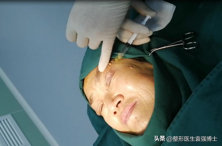 上眼皮松下垂该怎么办,上眼皮松弛耷拉怎么办