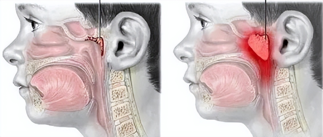 腺样体肥大孩子变丑,腺样体肥大大概几岁开始面貌变丑