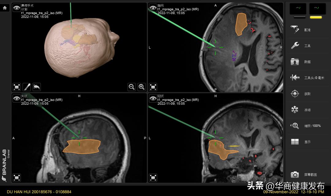 西北首台术中核磁共振登场！术中“核*器武**”精准制导切除多部位颅内肿瘤