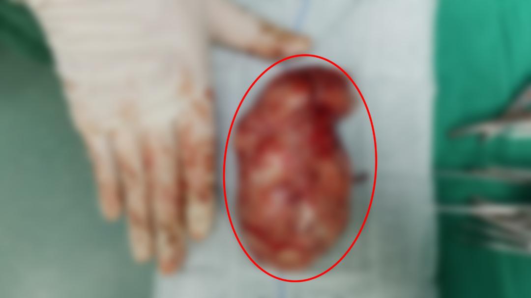 难言之隐泌尿外科,泌尿外科难言之隐