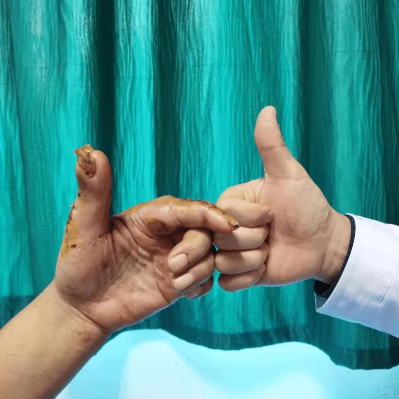 如何区别黑痣和黑色素瘤,怎么分清是黑色素瘤还是黑色的痣