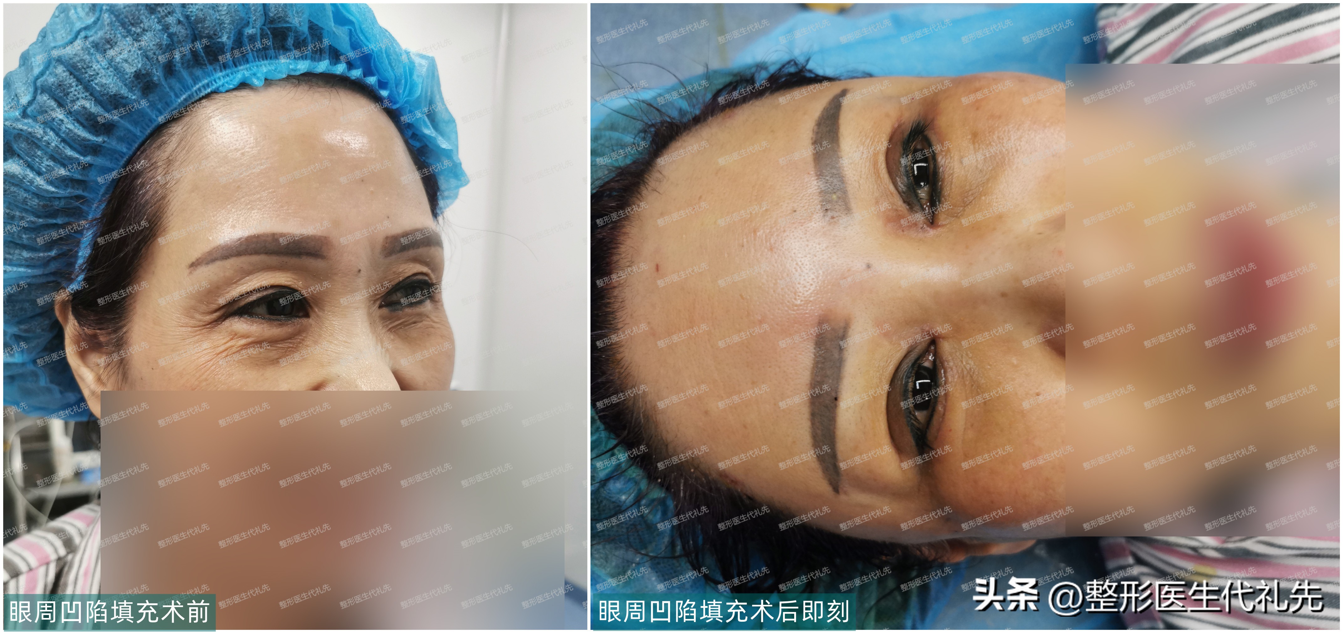 脸颊凹陷怎么改善最有效的方法,面颊衰老凹陷怎么改善