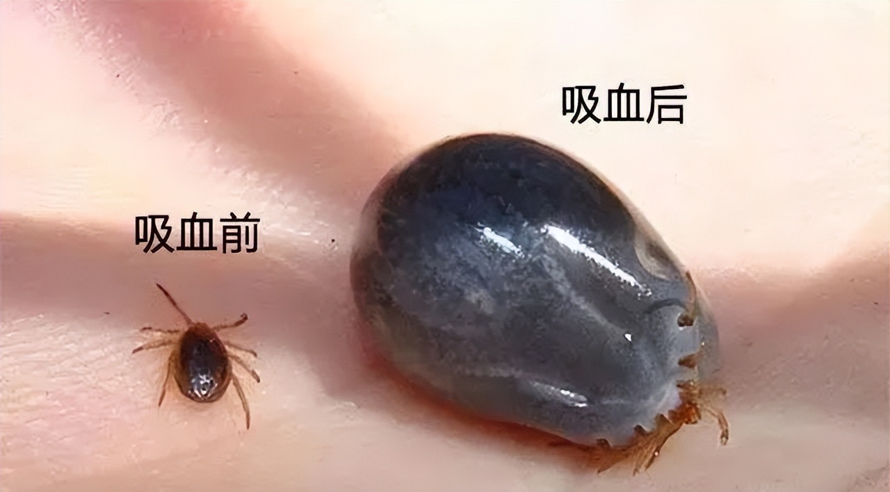 被蜱虫咬用火烤能拔出蜱虫吗,被蜱虫叮咬用烟烤行吗