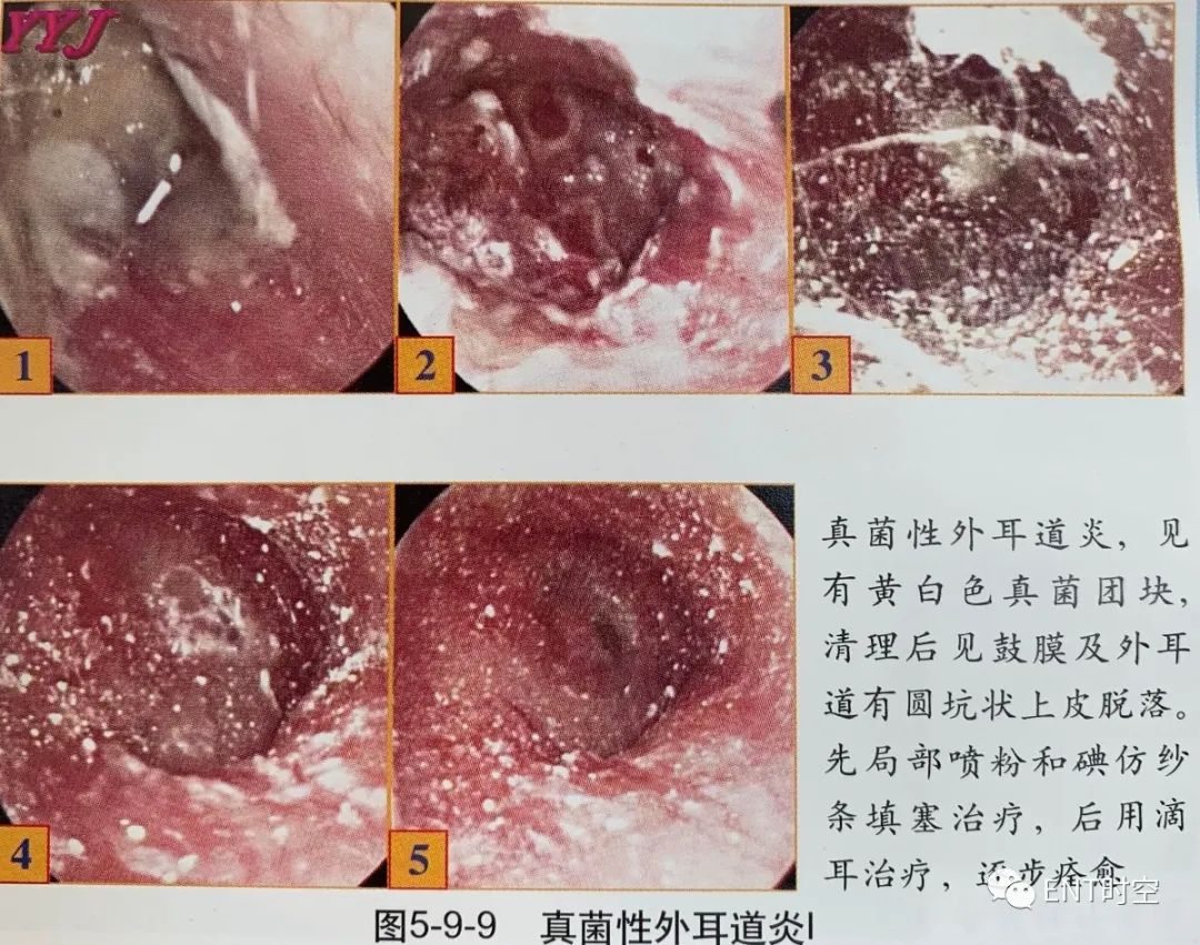 图文详解：真菌外耳道炎的诊治要点