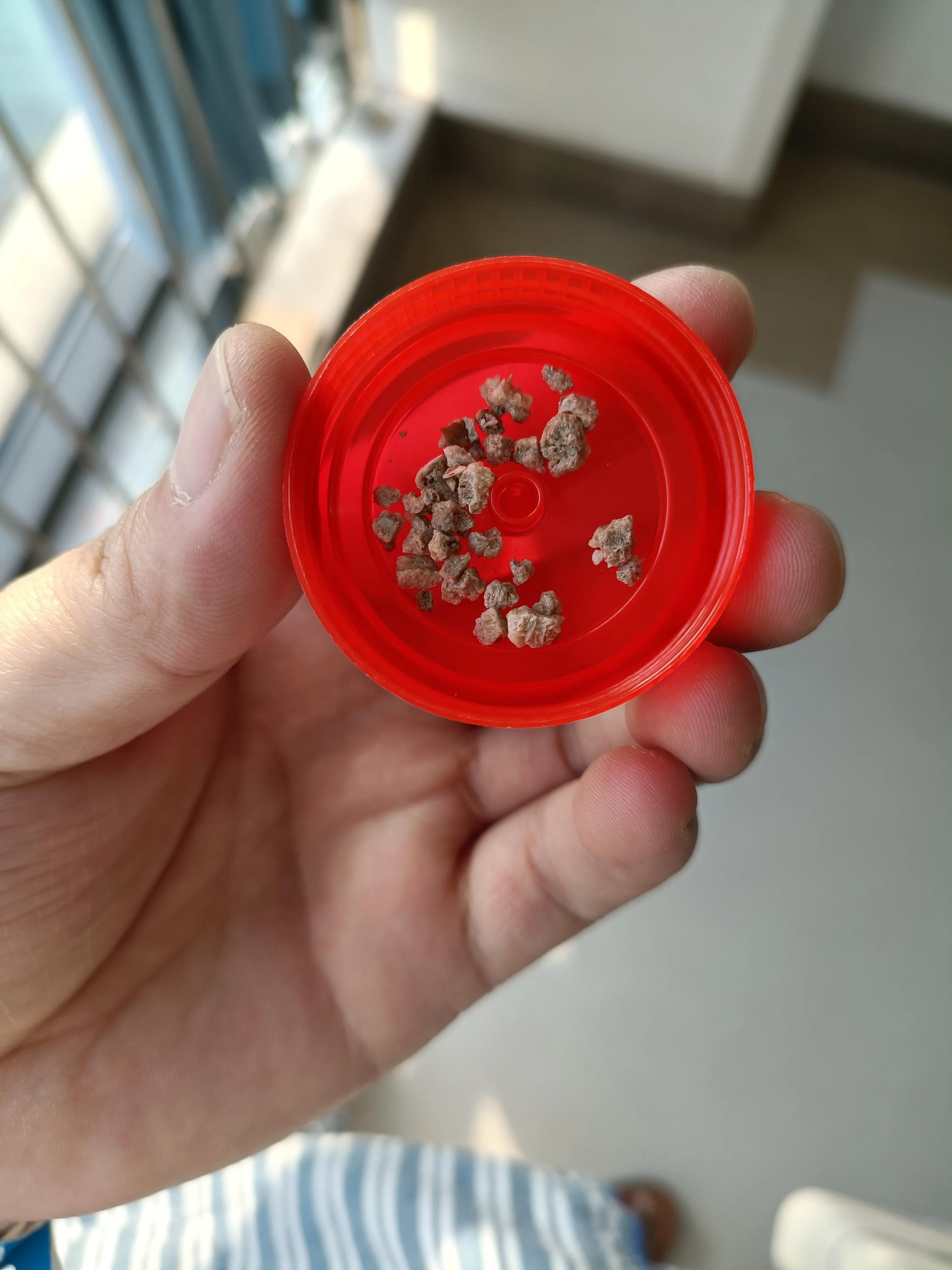 肾结石经皮肾镜两次手术间隔多久,两公分的肾结石需要动几次手术