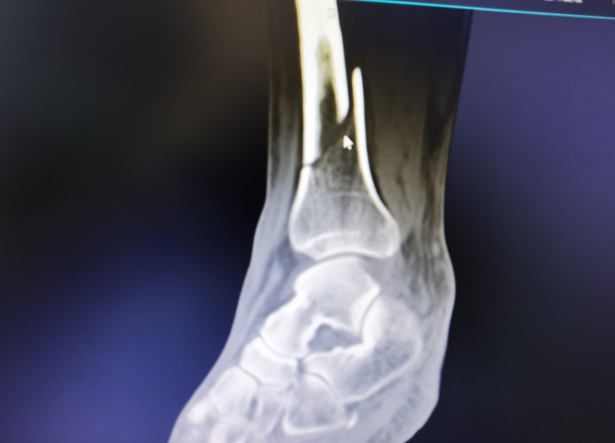 六旬大娘摔倒骨折,七旬老太太下公交车摔伤