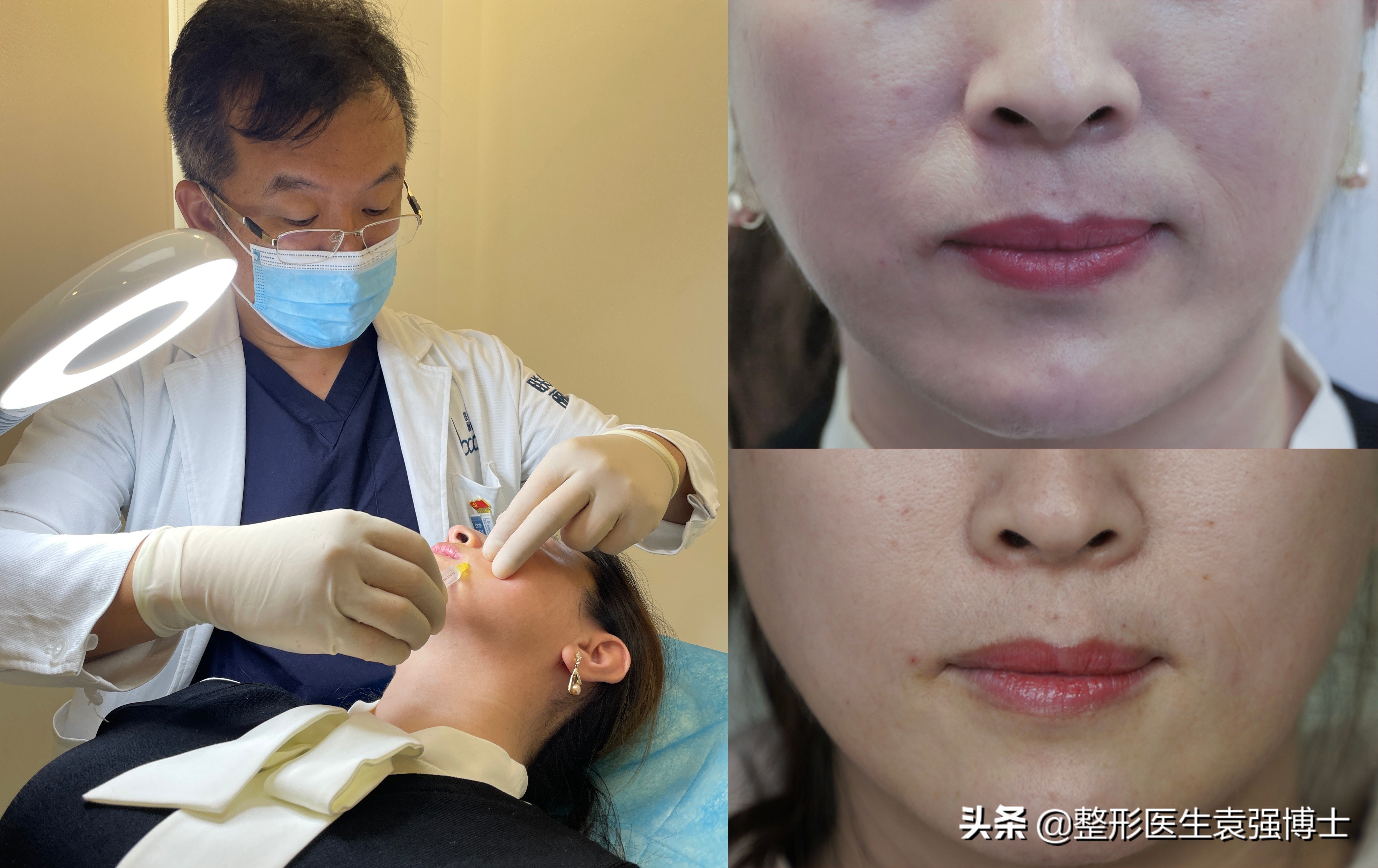 40岁去法令纹最好的方法,40岁就有很深的法令纹