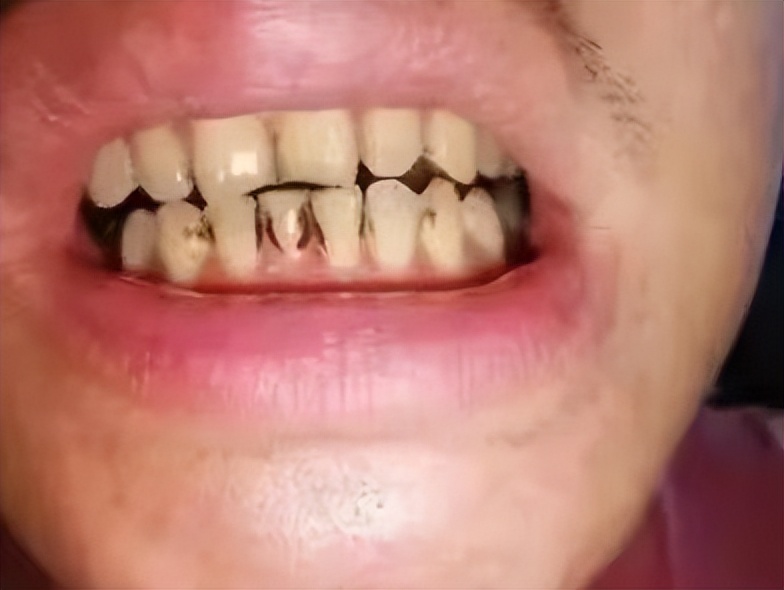 牙黄的克星一招搞定,牙黄小妙招立马见效