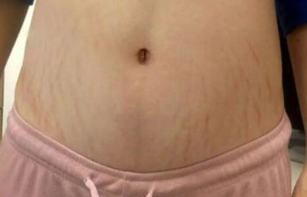 产后如何淡化妊娠纹一个妙招,产后淡化妊娠纹最有效的方法