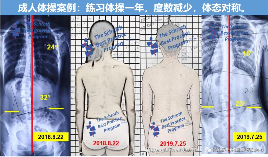 成人脊柱侧弯往哪弯,成年人脊柱侧弯怎么矫正